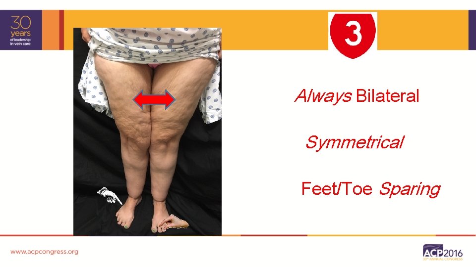 Always Bilateral Symmetrical Feet/Toe Sparing 