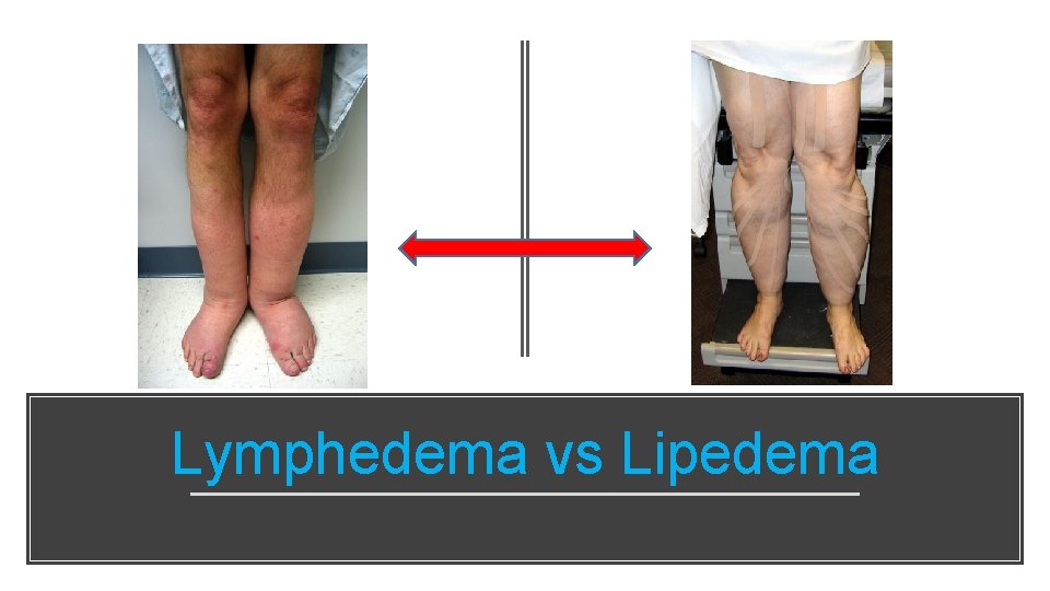 Lymphedema vs Lipedema 