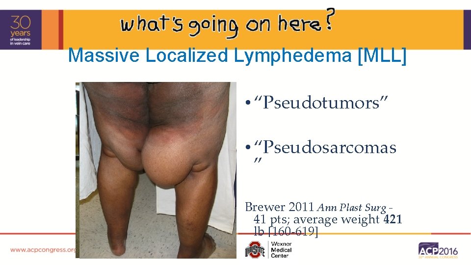 Massive Localized Lymphedema [MLL] • “Pseudotumors” • “Pseudosarcomas ” Brewer 2011 Ann Plast Surg