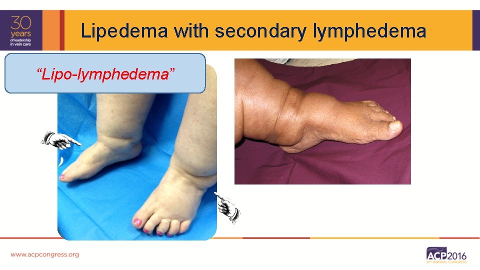Lipedema with secondary lymphedema “Lipo-lymphedema” 