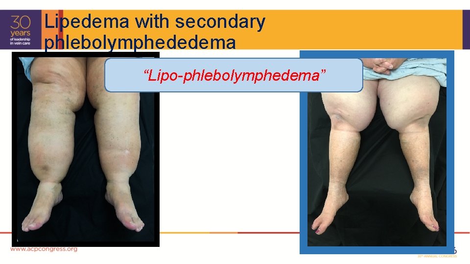 Lipedema with secondary phlebolymphededema “Lipo-phlebolymphedema” 