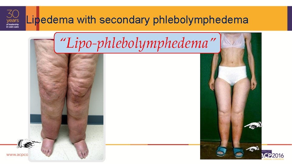 Lipedema with secondary phlebolymphedema “Lipo-phlebolymphedema” 