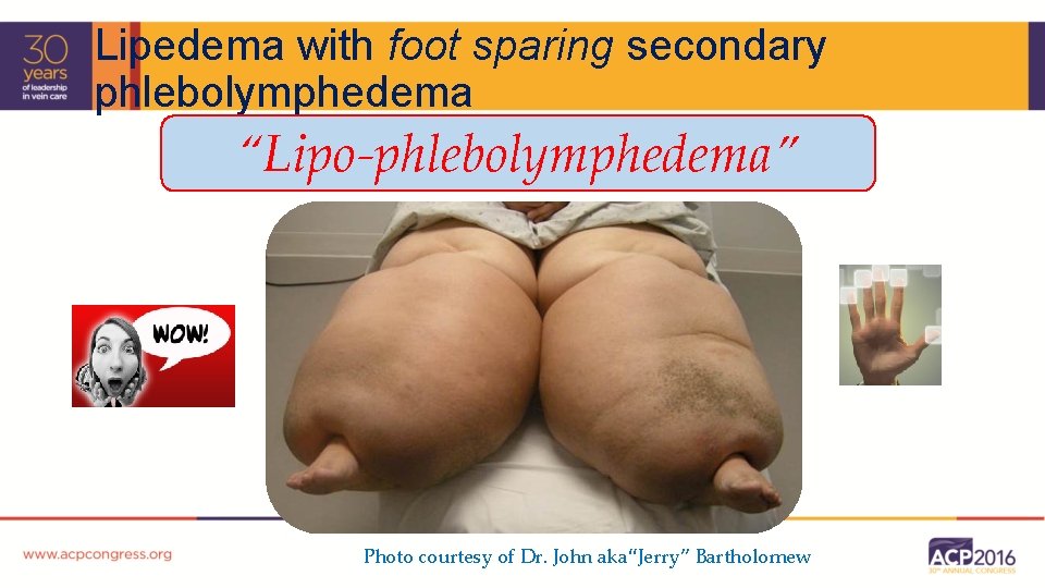 Lipedema with foot sparing secondary phlebolymphedema “Lipo-phlebolymphedema” Photo courtesy of Dr. John aka“Jerry” Bartholomew