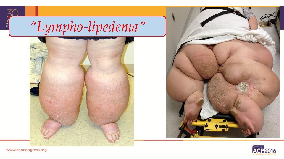“Lympho-lipedema” 