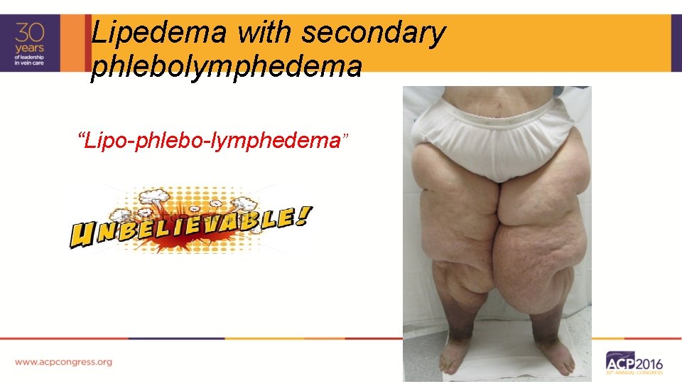 Lipedema with secondary phlebolymphedema “Lipo-phlebo-lymphedema” 