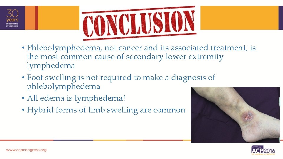  • Phlebolymphedema, not cancer and its associated treatment, is the most common cause