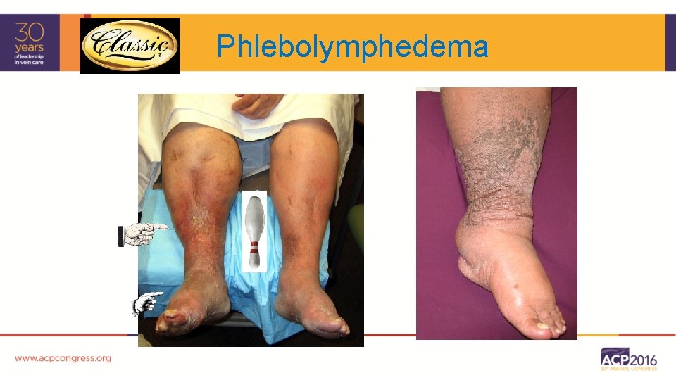 Phlebolymphedema 