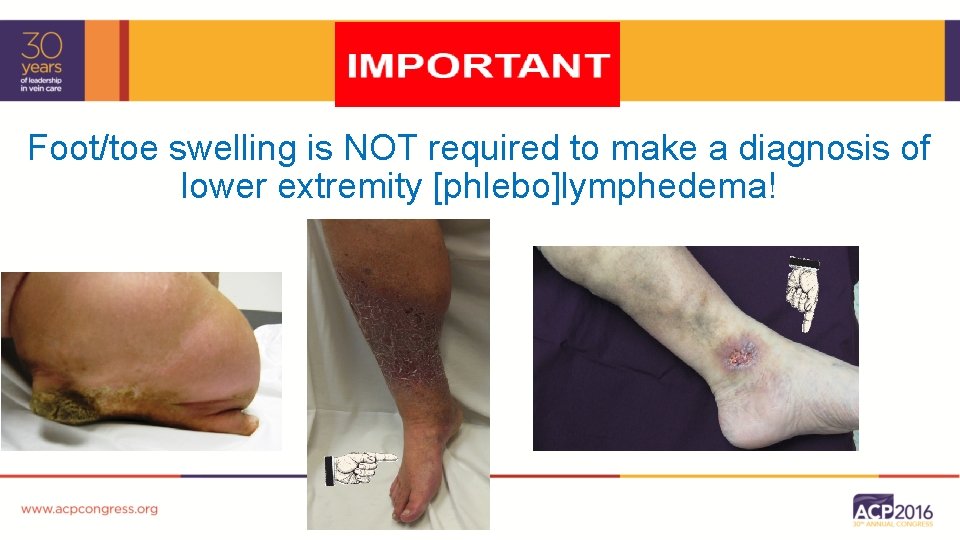 Foot/toe swelling is NOT required to make a diagnosis of lower extremity [phlebo]lymphedema! 