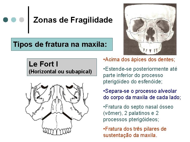 Zonas de Fragilidade Tipos de fratura na maxila: Le Fort I (Horizontal ou subapical)