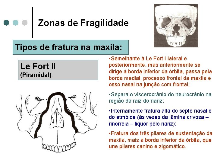 Zonas de Fragilidade Tipos de fratura na maxila: Le Fort II (Piramidal) • Semelhante