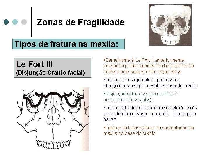 Zonas de Fragilidade Tipos de fratura na maxila: Le Fort III (Disjunção Crânio-facial) •