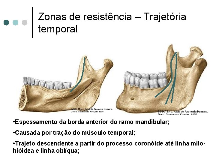 Zonas de resistência – Trajetória temporal • Espessamento da borda anterior do ramo mandibular;