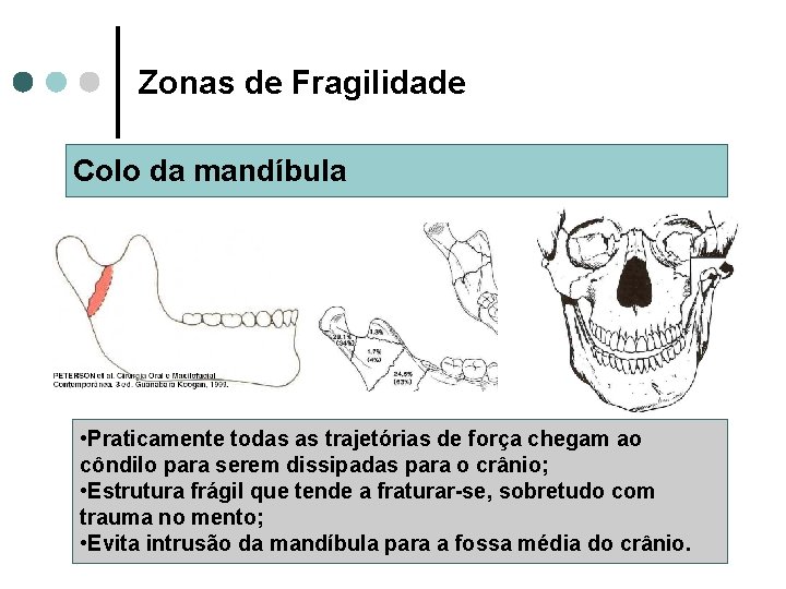 Zonas de Fragilidade Colo da mandíbula • Praticamente todas as trajetórias de força chegam