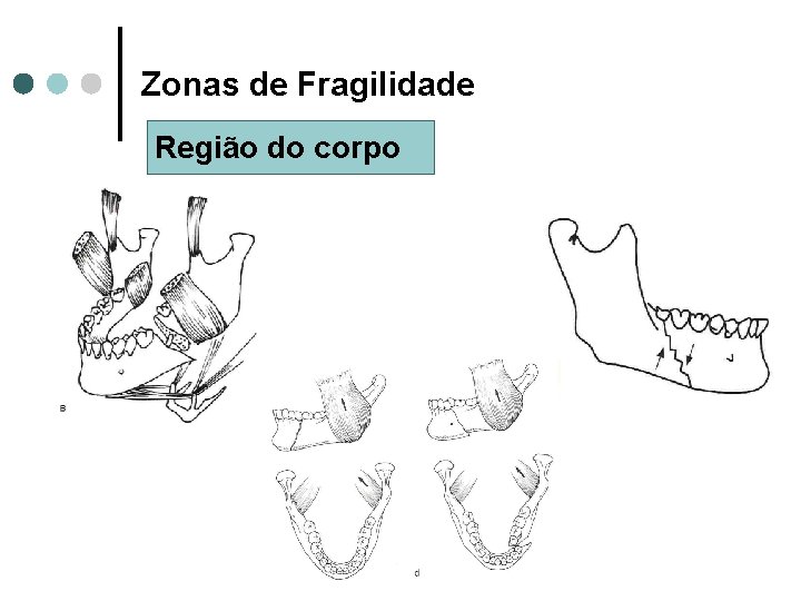 Zonas de Fragilidade Região do corpo 