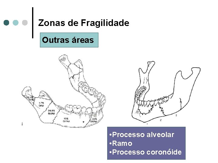 Zonas de Fragilidade Outras áreas • Processo alveolar • Ramo • Processo coronóide 