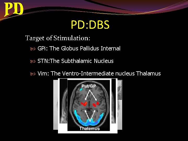PD: DBS Target of Stimulation: GPi: The Globus Pallidus Internal STN: The Subthalamic Nucleus