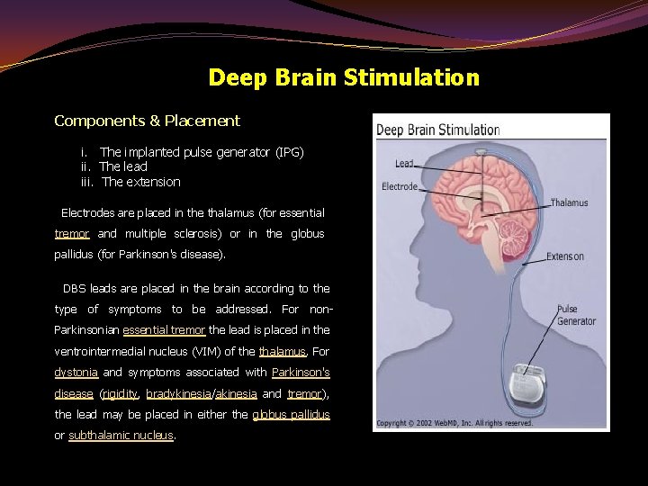 Deep Brain Stimulation Components & Placement i. The implanted pulse generator (IPG) ii. The