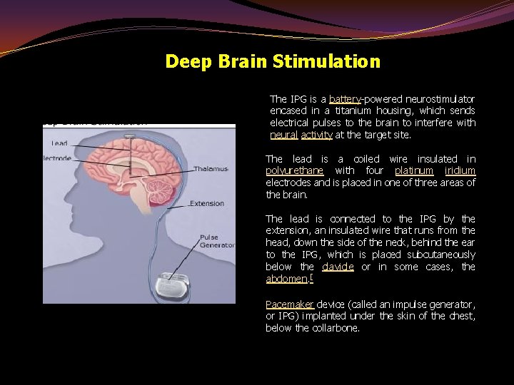 Deep Brain Stimulation The IPG is a battery-powered neurostimulator encased in a titanium housing,