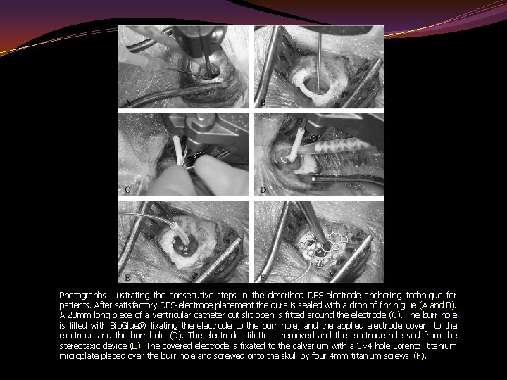 Photographs illustrating the consecutive steps in the described DBS-electrode anchoring technique for patients. After