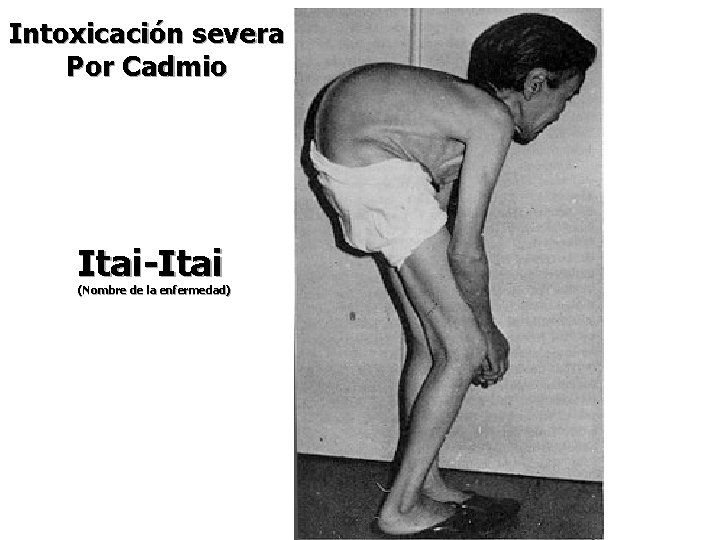 Intoxicación severa Por Cadmio Itai-Itai (Nombre de la enfermedad) 