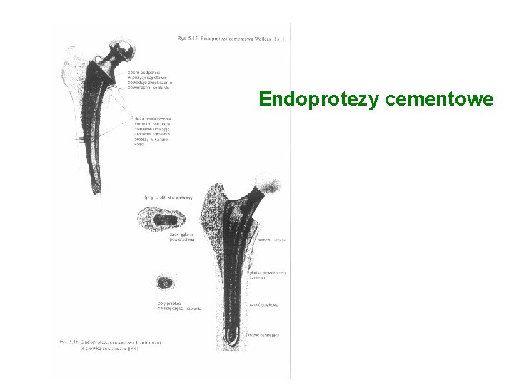 Endoprotezy cementowe 