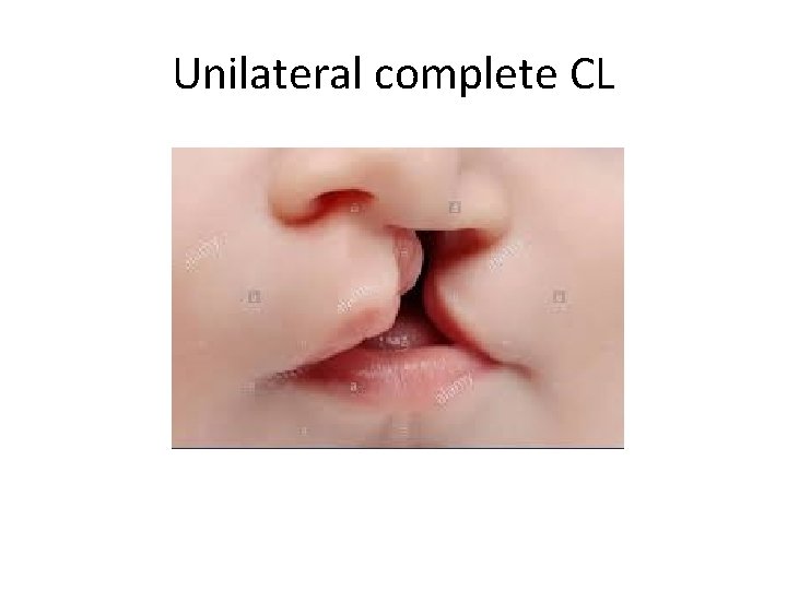 Unilateral complete CL 