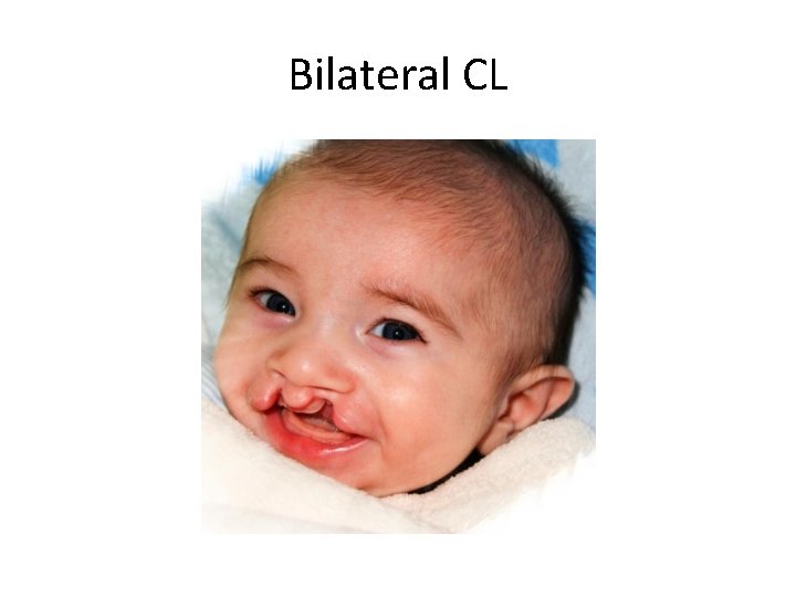 Bilateral CL 