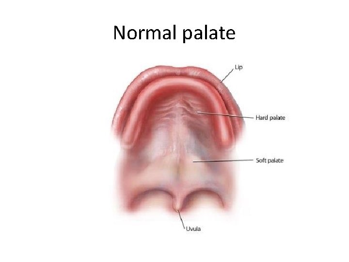 Normal palate 