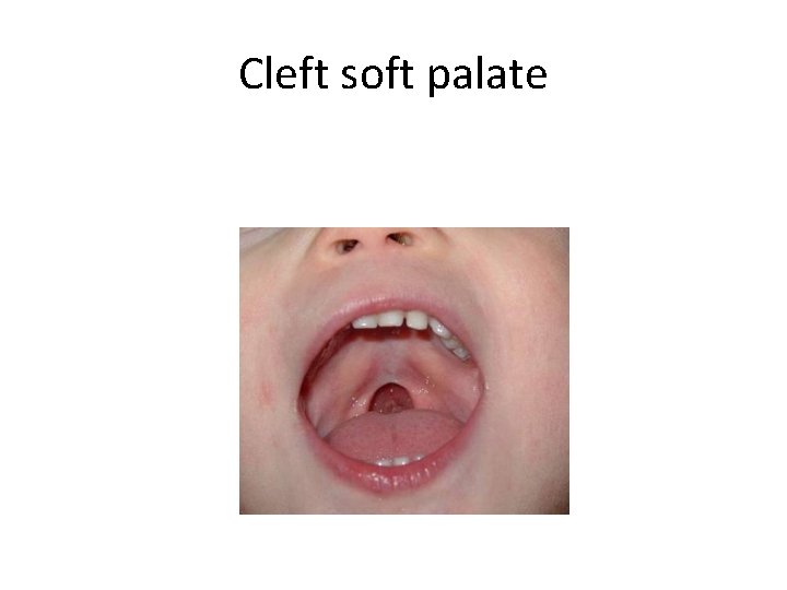 Cleft soft palate 