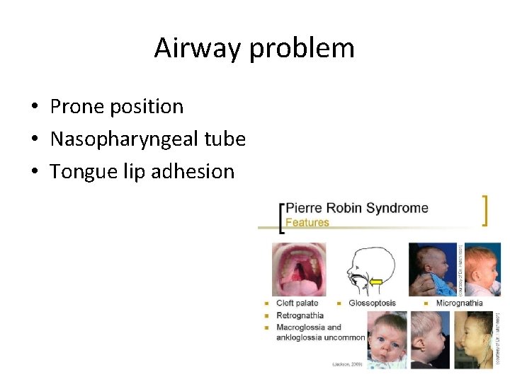 Airway problem • Prone position • Nasopharyngeal tube • Tongue lip adhesion 