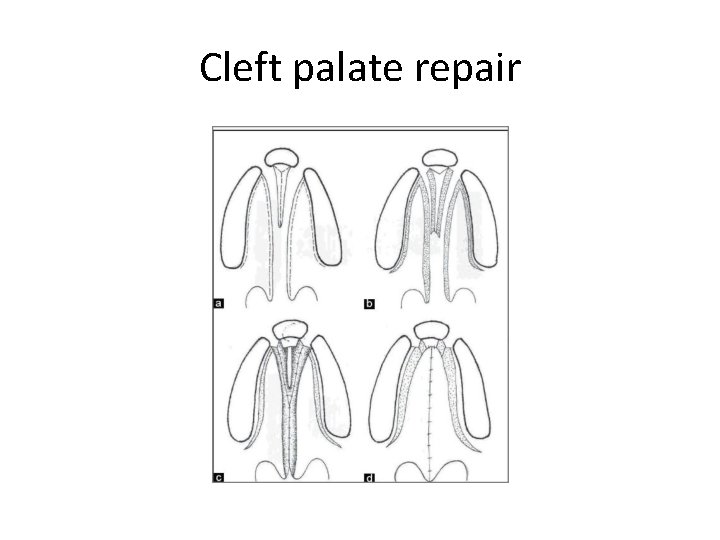 Cleft palate repair 