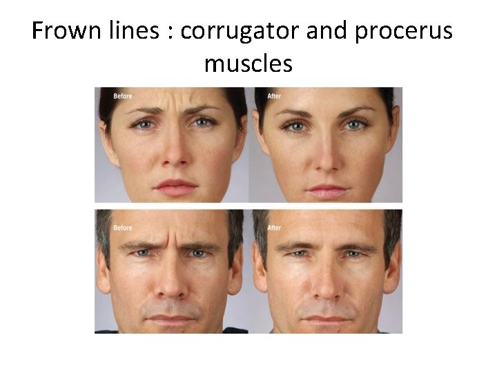 Frown lines : corrugator and procerus muscles 