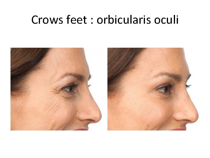 Crows feet : orbicularis oculi 