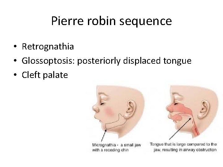 Pierre robin sequence • Retrognathia • Glossoptosis: posteriorly displaced tongue • Cleft palate 