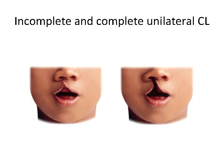 Incomplete and complete unilateral CL 