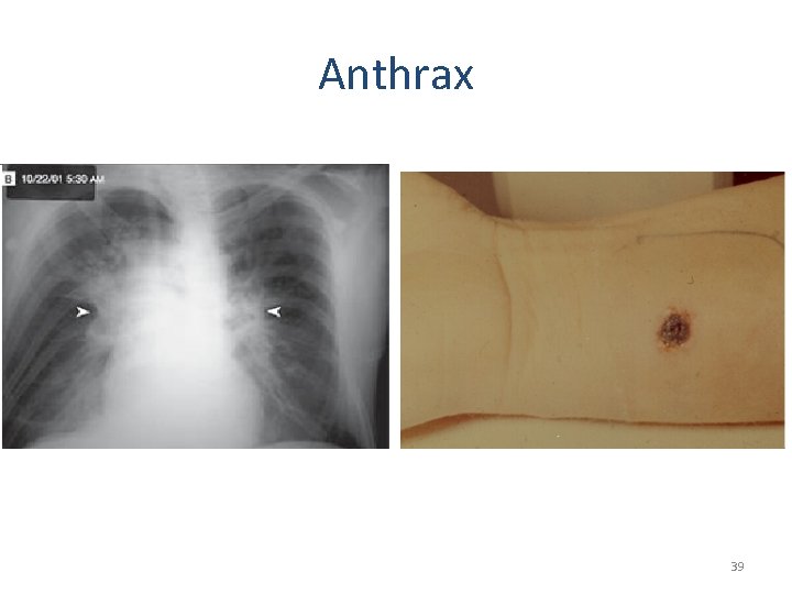 Anthrax Widening of medistinum Eschar on skin 39 