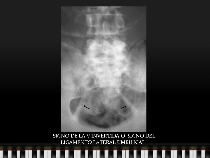 SIGNO DE LA V INVERTIDA O SIGNO DEL LIGAMENTO LATERAL UMBILICAL 
