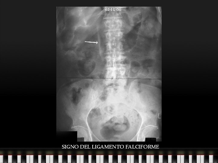 SIGNO DEL LIGAMENTO FALCIFORME 