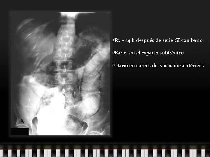 Rx - 24 h después de serie GI con bario. Bario en el espacio