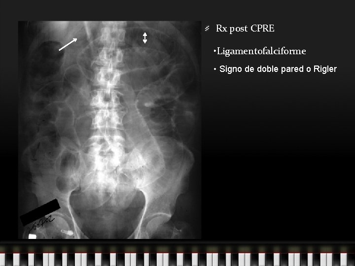 Rx post CPRE • Ligamentofalciforme • Signo de doble pared o Rigler 