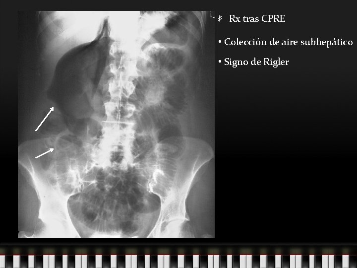 Rx tras CPRE • Colección de aire subhepático • Signo de Rigler 
