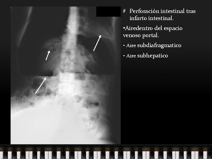 Perforación intestinal tras infarto intestinal. • Airedentro del espacio venoso portal. • Aire subdiafragmatico