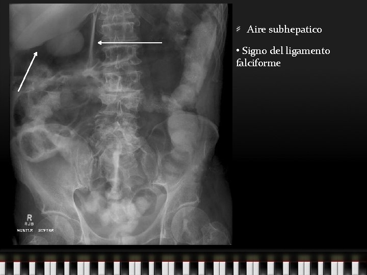 Aire subhepatico • Signo del ligamento falciforme 
