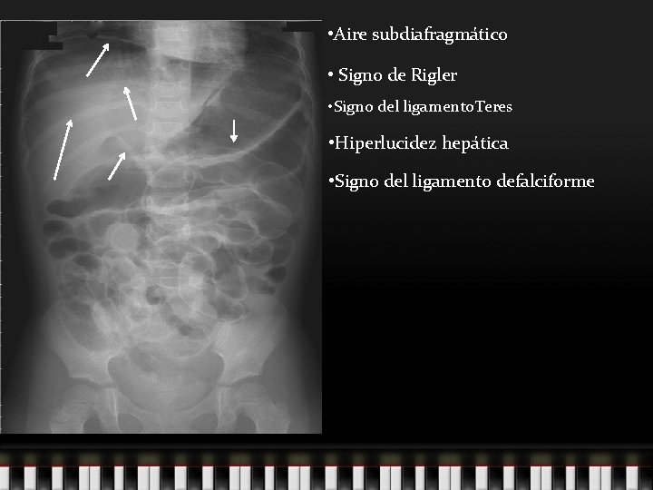  • Aire subdiafragmático • Signo de Rigler • Signo del ligamento. Teres •