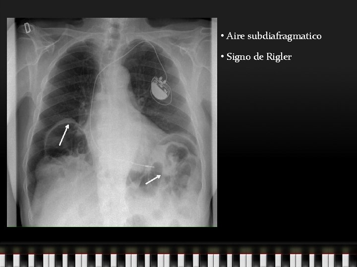  • Aire subdiafragmatico • Signo de Rigler 