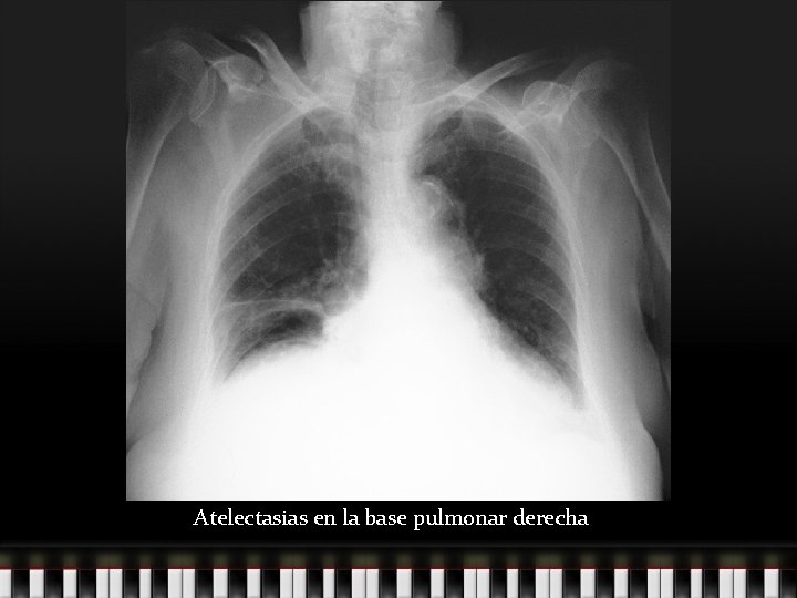 Atelectasias en la base pulmonar derecha 