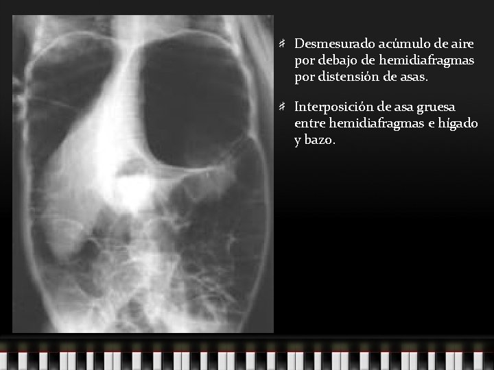 Desmesurado acúmulo de aire por debajo de hemidiafragmas por distensión de asas. Interposición de