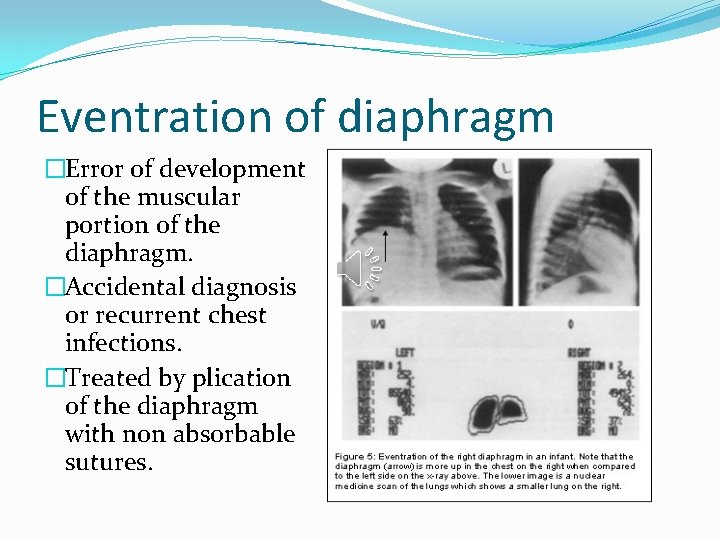 Eventration of diaphragm �Error of development of the muscular portion of the diaphragm. �Accidental