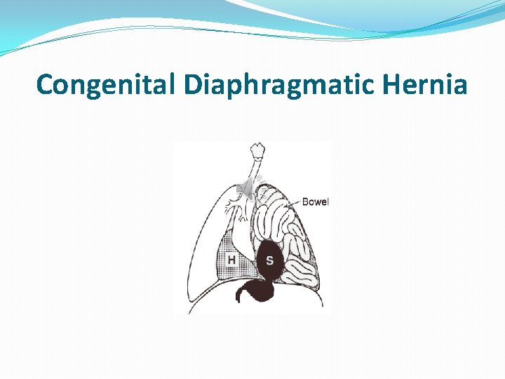 Congenital Diaphragmatic Hernia 