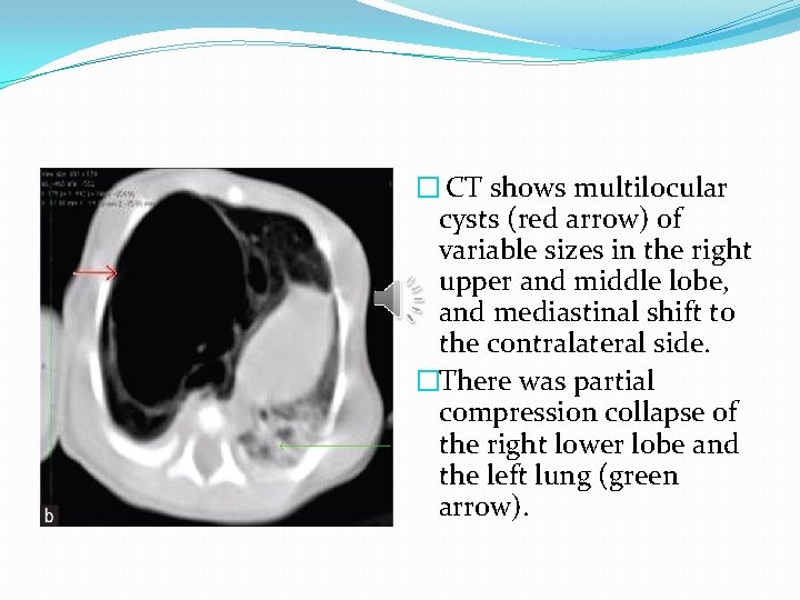 � CT shows multilocular cysts (red arrow) of variable sizes in the right upper